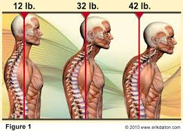 Forward Head Posture. Posture correction chiropractic treatment in Brick